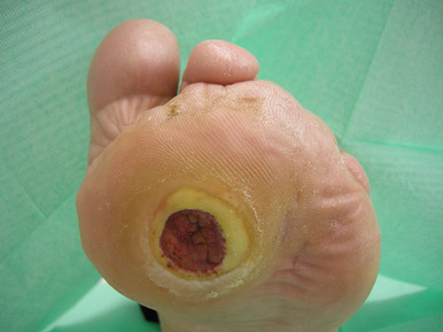 Caso di ulcera neuropatica
