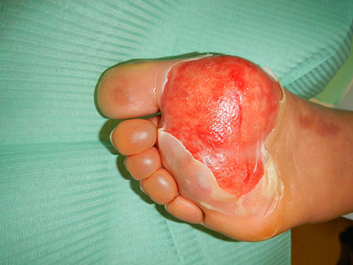 Caso di ustione dovuto a neuropatia periferica