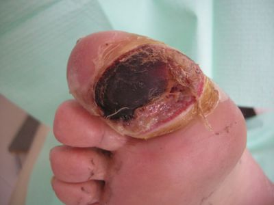 Esempio di ulcera ischemica all'alluce