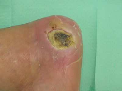 lesione-ischemica-calcagno-01.jpg