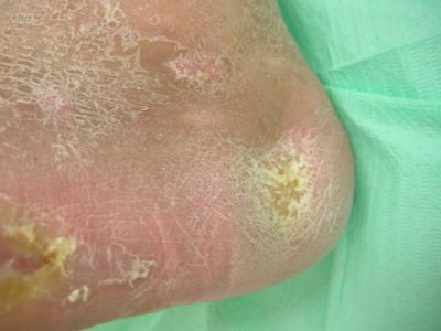 lesione-ischemica-calcagno-05.jpg