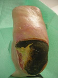 lesione-necrotica-calcagno-01.jpg