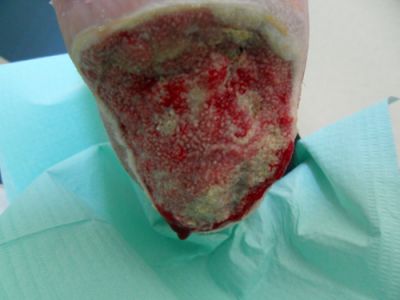 lesione-necrotica-calcagno-03.jpg