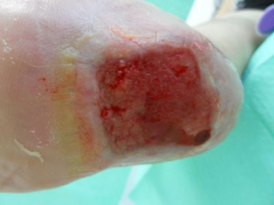 lesione-necrotica-calcagno-05.jpg