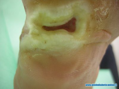 ulcera-plantare-neuropatica-04.jpg