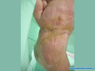 ulcera-plantare-neuropatica-07.jpg