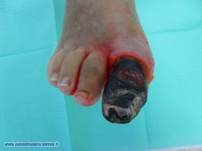 gangrena-1-dito-01.jpg