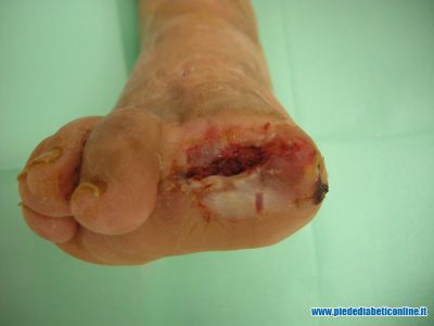 gangrena-1-dito-02.jpg