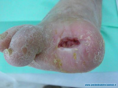 gangrena-1-dito-03.jpg