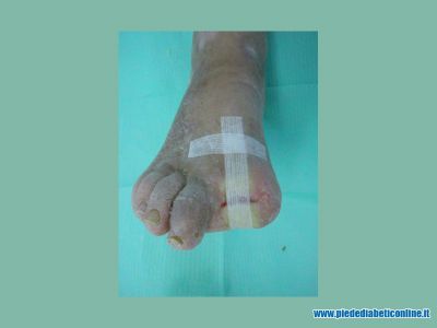 gangrena-1-dito-04.jpg