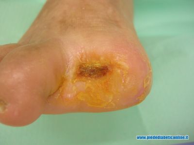 gangrena-1-dito-05.jpg