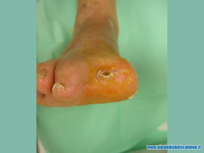 gangrena-1-dito-06.jpg
