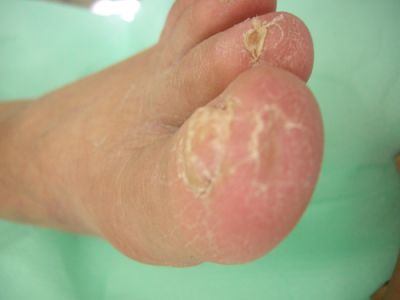 lesione-ischemica-1-dito-06.jpg