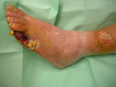 gangrena-5-dito-01.jpg