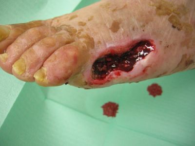 gangrena-5-dito-02.jpg