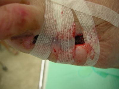 gangrena-5-dito-03.jpg