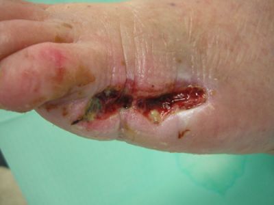 gangrena-5-dito-04.jpg