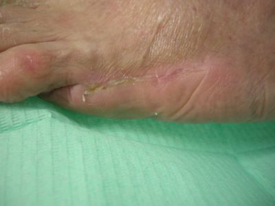 gangrena-5-dito-05.jpg